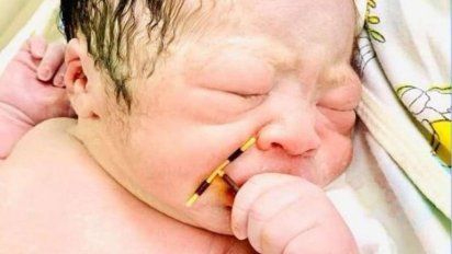 La imagen que impactó al mundo: un bebé nació con el DIU de su madre en la mano