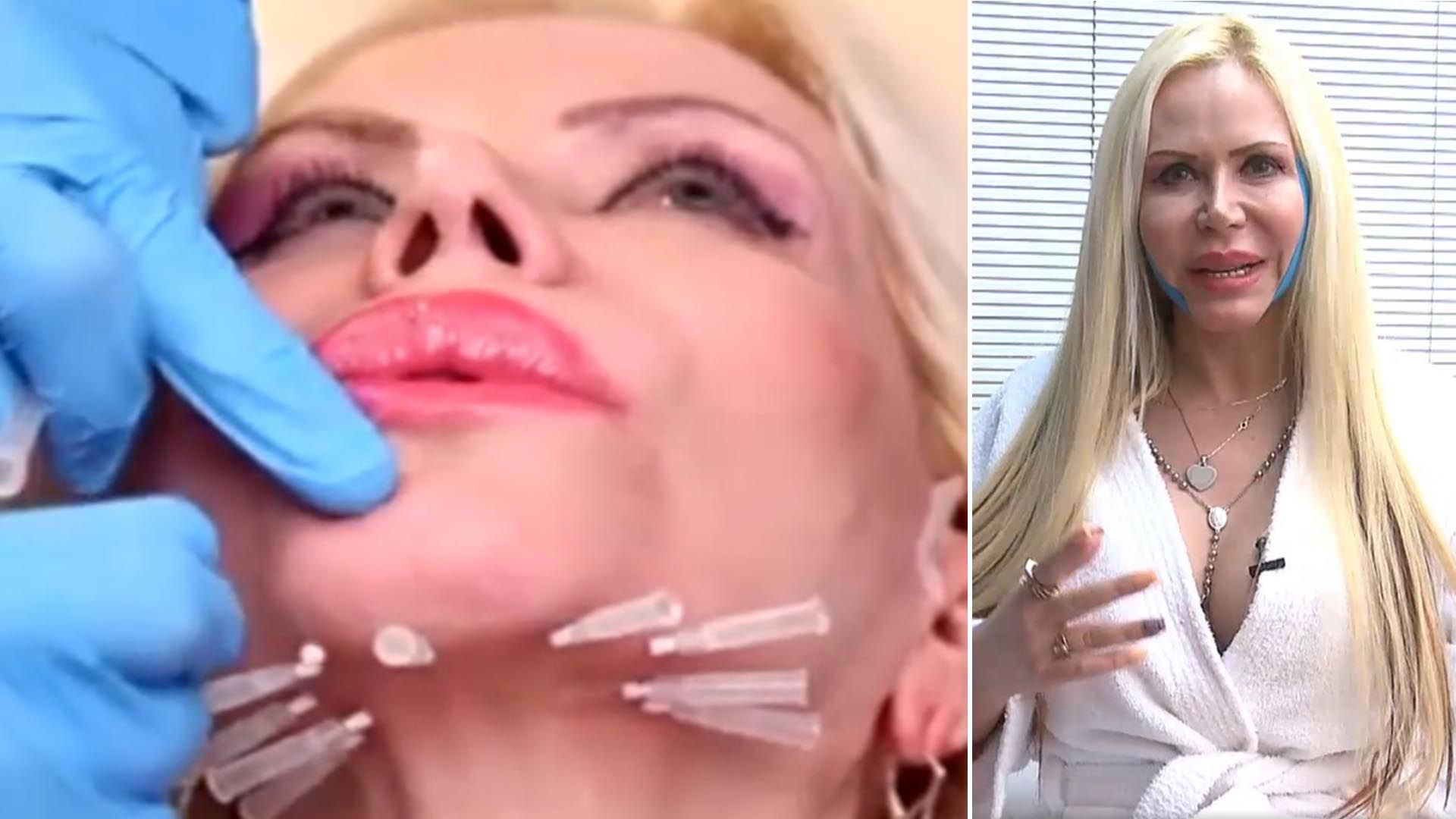 ¿Cuántas cirugías tiene Alejandra Pradón?