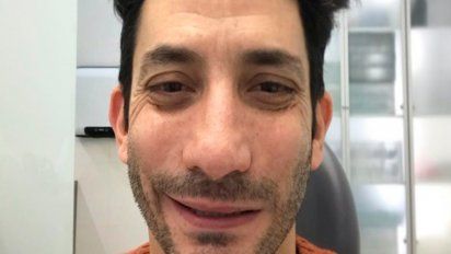 ¿Por qué Juan Minujín se operó la boca? 