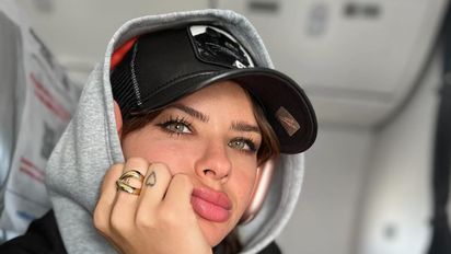 La China Suárez dio detalles del accidente que tuvo en la cara