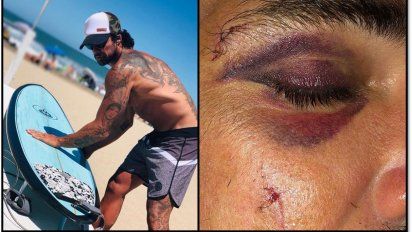 Luciano Castro accidentado: puntos y un ojo morado